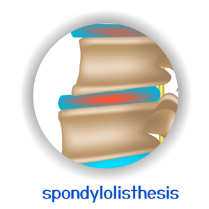 image of Nashua chiropractic spondylolisthesis